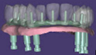 Ponte sobre Implantes tipo "Wrap around"