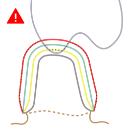 D Cut-locally-to-antagonist adjacents 250.gif