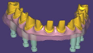 Ponte sobre Implantes tipo "Coroa Dedal"