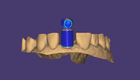 Matching the scan abutments