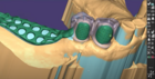 Adding retention beads to imported parts