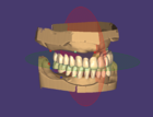 Editing Denture tooth placement