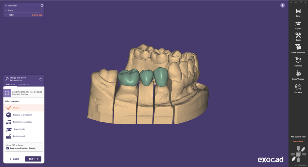Pre-op-and-waxup-06.png
