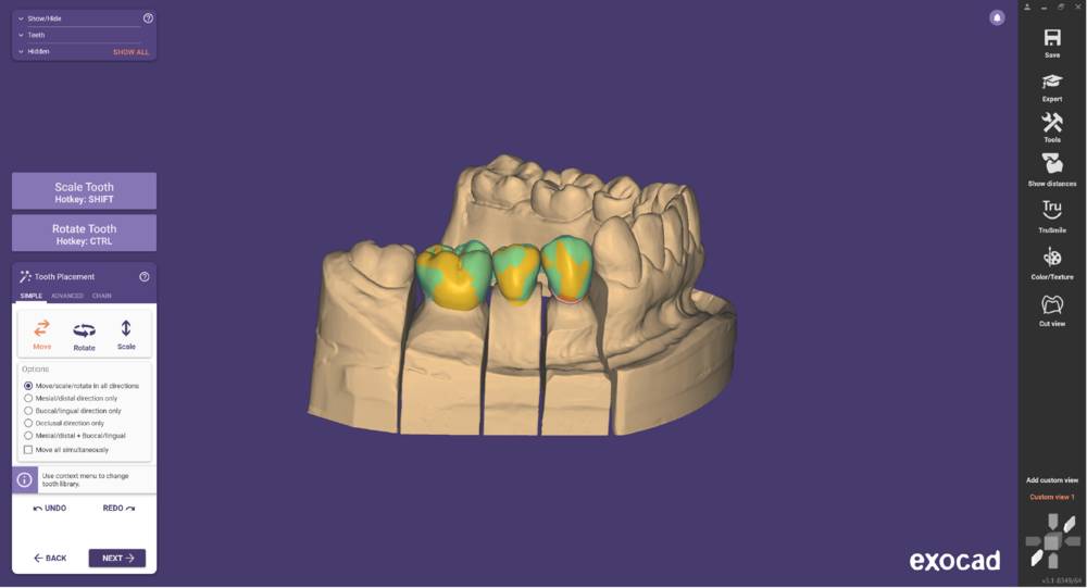 Pre-op-and-waxup-02.png