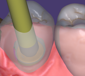Exocad-support-190-3.png
