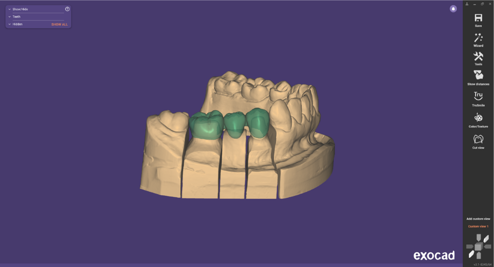 Pre-op-and-waxup-09.png