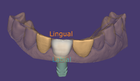 Posicionamento de dentes