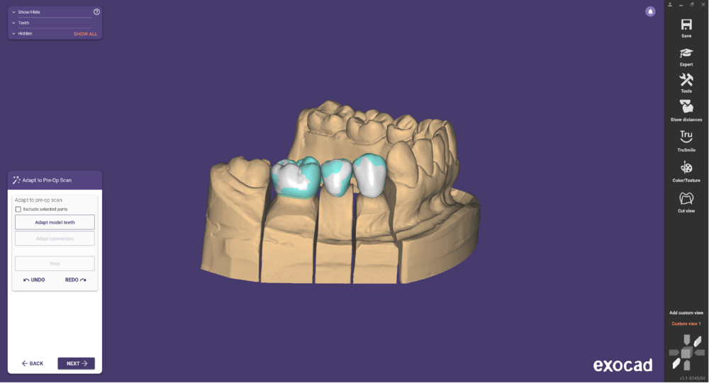 Pre-op-and-waxup-04.png