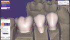 Watch our training video section about tooth setup