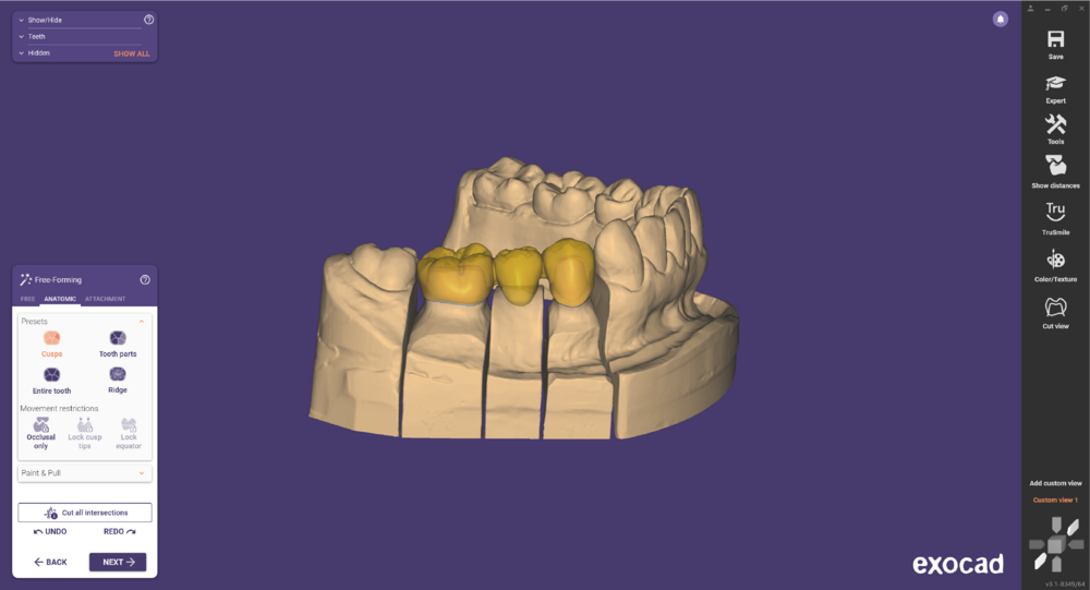 Pre-op-and-waxup-10.png