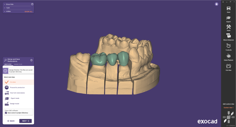 Pre-op-and-waxup-11.png
