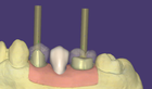 Editing Abutment design