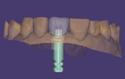 Editar o design da base do abutment