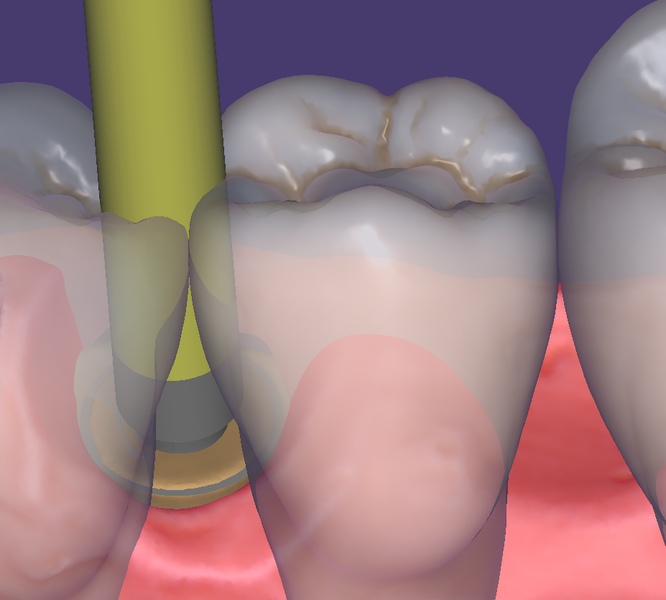 File:Exocad-support-190-4.png