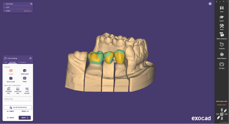 File:Pre-op-and-waxup-03.png