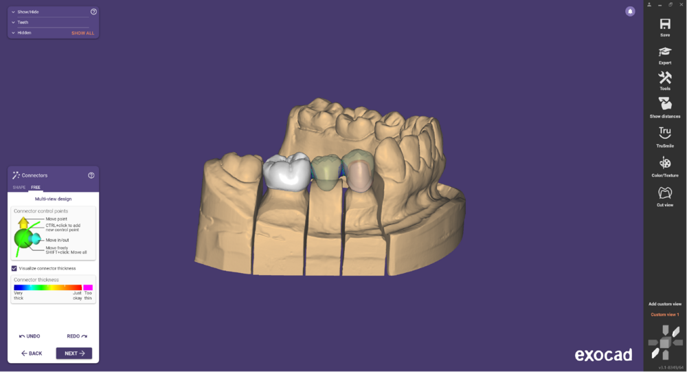 Pre-op-and-waxup-05.png
