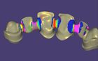 Design de uma ponte incluindo um pilar personalizado e attachments com faces linguais fresadas usando Smile Design