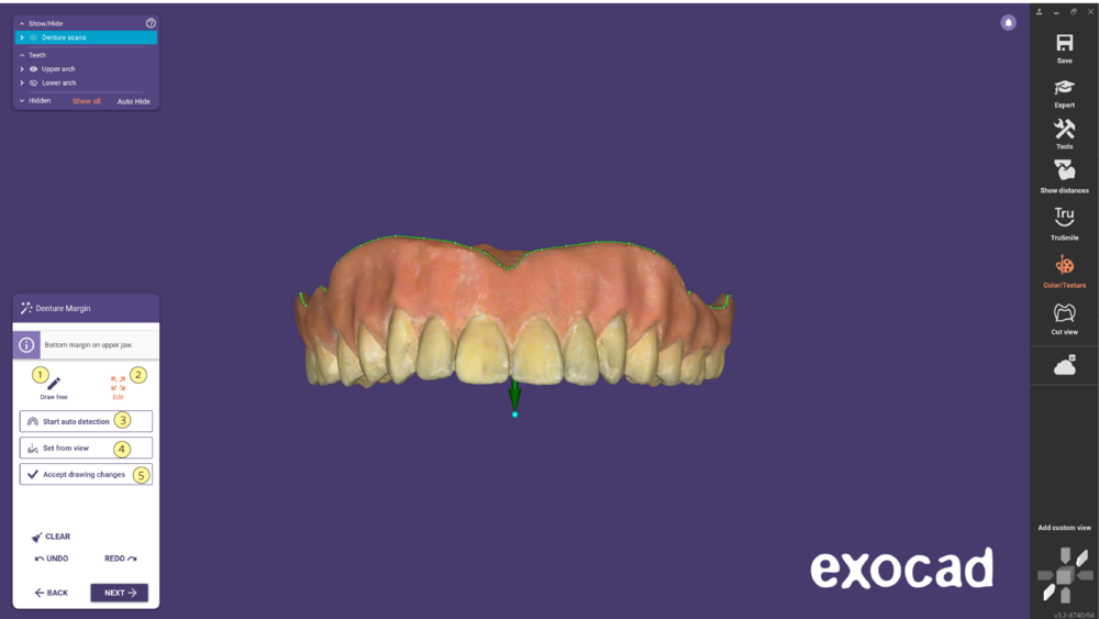 Duplicate denture-07.png