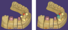 Virtual Tooth Extraction