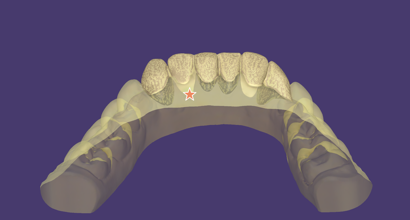 File:ProvisionalPontic.png