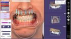 Ponte sobre Implante tipo Thimble com Smile Design