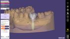 Fluxo de Trabalho de Carga Imediata com exoplan e exocad DentalCAD