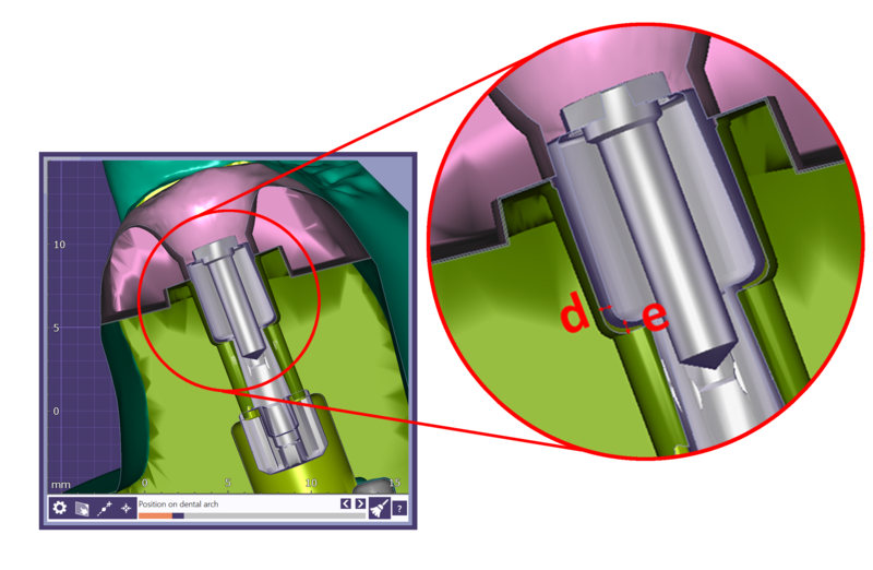 ImplantModelLabAnalogOffset.png
