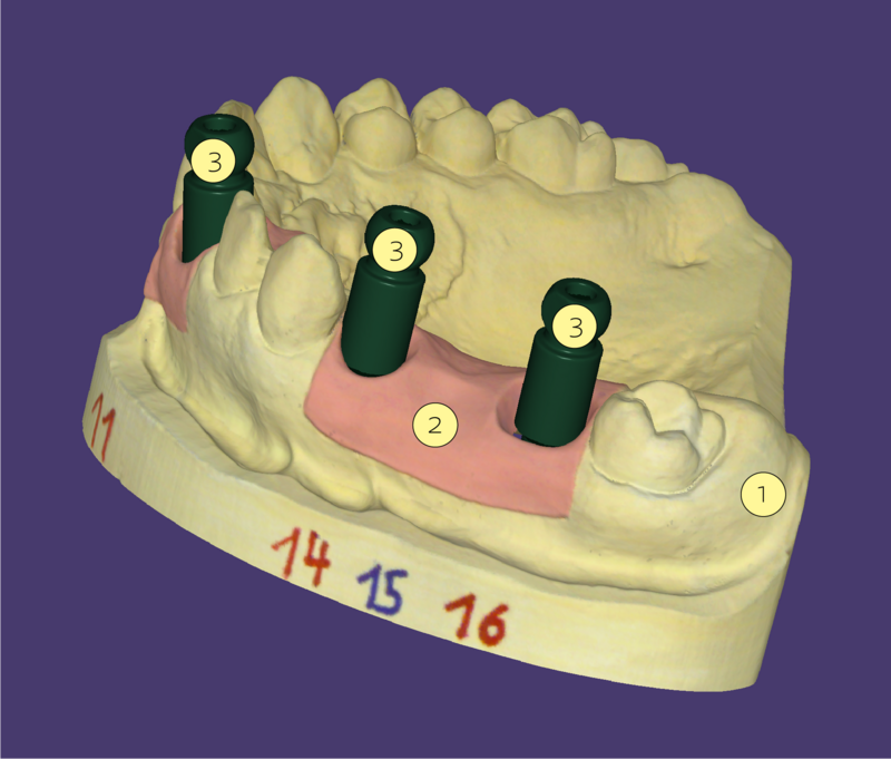 Implant based restoration.png