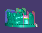 Implant Model, Model segmentation